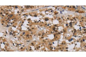 Immunohistochemistry of paraffin-embedded Human thyroid cancer tissue using E2F4 Polyclonal Antibody at dilution 1:40 (E2F4 anticorps)