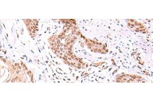 Immunohistochemistry of paraffin-embedded Human esophagus cancer tissue using TRMT12 Polyclonal Antibody at dilution of 1:80(x200) (TRMT12 anticorps)