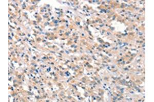 The image on the left is immunohistochemistry of paraffin-embedded Human thyroid cancer tissue using ABIN7191162(KCNB1 Antibody) at dilution 1/40, on the right is treated with synthetic peptide.