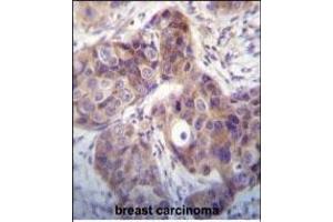 Kallikrein 6(KLK6) Antibody (N-term) (ABIN652195 and ABIN2840741) immunohistochemistry analysis in formalin fixed and paraffin embedded human breast carcinoma followed by peroxidase conjugation of the secondary antibody and DAB staining.