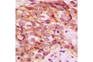 Immunohistochemical analysis of Glycerate Kinase staining in human breast cancer formalin fixed paraffin embedded tissue section.