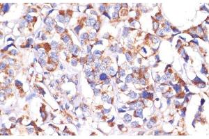 Immunohistochemistry of paraffin-embedded Human breast cancer using STOML2 Polyclonal Antibody at dilution of 1:100 (40x lens).