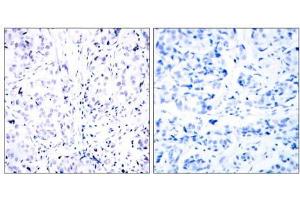 Immunohistochemical analysis of paraffin-embedded human breast carcinoma tissue using Rb (Ab-807) antibody (E021109). (Retinoblastoma 1 anticorps)