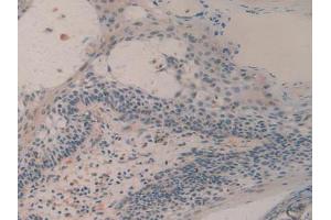 IHC-P analysis of Human Skin Cancer Tissue, with DAB staining. (H2AFY anticorps  (AA 109-369))