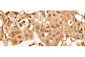 Immunohistochemistry of paraffin-embedded Human colorectal cancer tissue using BRF2 Polyclonal Antibody at dilution of 1:40(x200) (BRF2 anticorps)