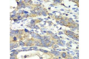 Immunohistochemistry of paraffin-embedded Human gastric cancer using CHMP2B Polyclonal Antibody at dilution of 1:100 (40x lens). (CHMP2B anticorps)