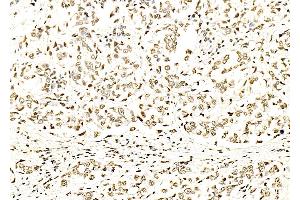 Histone H3 Antibody at 1/100 staining Human liver cancer by IHC-P.
