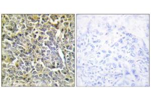 Immunohistochemistry analysis of paraffin-embedded human lung carcinoma tissue using COL6A2 antibody. (COL6A2 anticorps  (Internal Region))