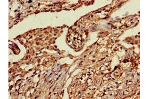 Immunohistochemistry of paraffin-embedded human lung cancer using ABIN7164763 at dilution of 1:100 (PRR11 anticorps  (AA 1-360))