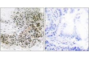 Immunohistochemistry analysis of paraffin-embedded human lung carcinoma tissue, using TRPS1 Antibody. (TRPS1 anticorps  (AA 121-170))