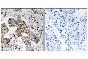 Immunohistochemistry analysis of paraffin-embedded human breast carcinoma tissue using KCNK15 antibody. (KCNK15 anticorps  (C-Term))