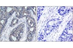 Immunohistochemistry analysis of paraffin-embedded human breast carcinoma, using IRS-1 (Phospho-Ser636) Antibody. (IRS1 anticorps  (pSer636))