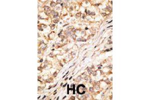 Formalin-fixed and paraffin-embedded human hepatocellular carcinoma tissue reacted with GJD2 polyclonal antibody  , which was peroxidase-conjugated to the secondary antibody, followed by DAB staining. (GJD2 anticorps  (C-Term))