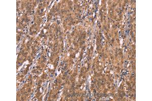 Immunohistochemistry of Human colon cancer using FBXO31 Polyclonal Antibody at dilution of 1:40 (FBXO31 anticorps)