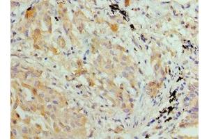 Immunohistochemistry of paraffin-embedded human lung cancer using ABIN7155429 at dilution of 1: 100