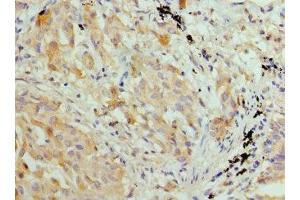 Immunohistochemistry of paraffin-embedded human lung cancer using ABIN7155429 at dilution of 1: 100 (HIST2H3A anticorps  (AA 108-136))