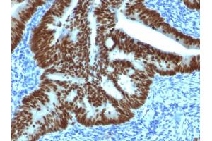 Formalin-fixed, paraffin-embedded human Colon Carcinoma stained with CDX2 Mouse Monoclonal Antibody (CDX2/1690).