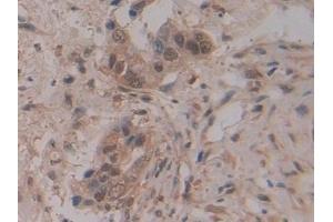 Detection of RI in Human Pancreatic cancer Tissue using Polyclonal Antibody to Ribonuclease Inhibitor (RI)