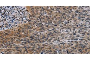 Immunohistochemistry of paraffin-embedded Human cervical cancer tissue using CCL1 Polyclonal Antibody at dilution 1:50 (CCL1 anticorps)