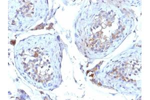 Formalin-fixed, paraffin-embedded human Testicular Carcinoma stained with SHBG Mouse Monoclonal Antibody (SHBG/245). (SHBG anticorps)