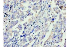 Immunohistochemistry of paraffin-embedded human lung cancer using ABIN7144040 at dilution of 1:100 (FE65 anticorps  (AA 361-710))
