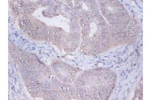 Immunohistochemistry of paraffin-embedded human colon cancer using ABIN7153940 at dilution of 1:100 (PRKCSH anticorps  (AA 15-302))