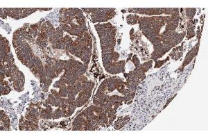 IHC-P Image Immunohistochemical analysis of paraffin-embedded human gastric cancer, using CXCR7, antibody at 1:100 dilution.
