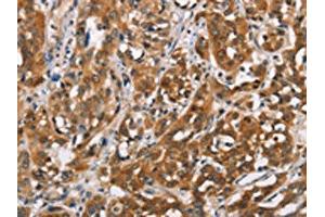 The image on the left is immunohistochemistry of paraffin-embedded Human esophagus cancer tissue using ABIN7192349(SH2B2 Antibody) at dilution 1/30, on the right is treated with synthetic peptide. (SH2B2 anticorps)
