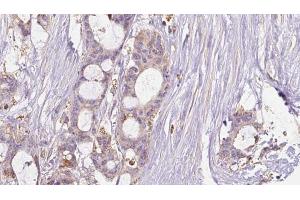 ABIN6267634 at 1/100 staining Human liver cancer tissue by IHC-P. (GRIN2B anticorps  (pTyr1474))