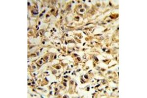 Formalin-fixed and paraffin-embedded human breast carcinoma reacted with MAT2B Antibody (N-term) followed which was peroxidase-conjugated to the secondary antibody, followed by DAB staining. (MAT2B anticorps  (N-Term))