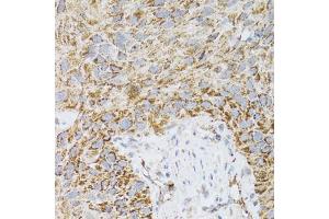 Immunohistochemistry of paraffin-embedded human lung cancer using PDYN antibody (ABIN2564462) at dilution of 1:100 (40x lens). (PDYN anticorps)