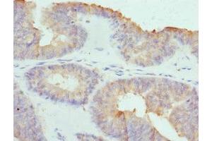 Immunohistochemistry of paraffin-embedded human endometrial cancer using ABIN7148039 at dilution of 1:100 (COCH anticorps  (AA 20-260))