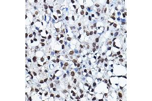Immunohistochemistry of paraffin-embedded human breast cancer using K Rabbit pAb (ABIN6128005, ABIN6142689, ABIN6142690 and ABIN6221516) at dilution of 1:100 (40x lens).