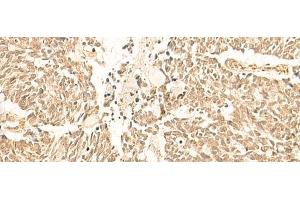 Immunohistochemistry of paraffin-embedded Human lung cancer tissue using TBPL1 Polyclonal Antibody at dilution of 1:50(x200) (TBPL1 anticorps)