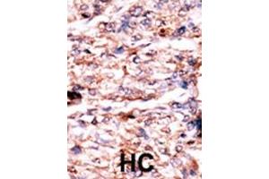 Formalin-fixed and paraffin-embedded human cancer tissue reacted with the primary antibody, which was peroxidase-conjugated to the secondary antibody, followed by AEC staining.