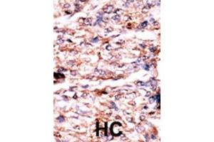 Formalin-fixed and paraffin-embedded human cancer tissue reacted with the primary antibody, which was peroxidase-conjugated to the secondary antibody, followed by AEC staining. (PSKH1 anticorps  (N-Term))