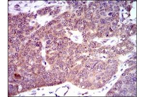Immunohistochemical analysis of paraffin-embedded ovarian cancer tissues using PDE1B mouse mAb with DAB staining.