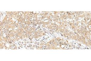 Immunohistochemistry of paraffin-embedded Human esophagus cancer tissue using CHRNB2 Polyclonal Antibody at dilution of 1:50(x200) (CHRNB2 anticorps)