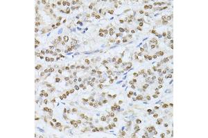 Immunohistochemistry of paraffin-embedded human colon carcinoma using SATB1 antibody.