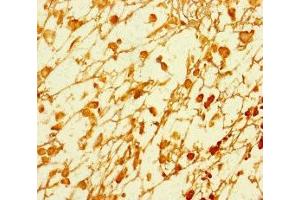 Immunohistochemistry of paraffin-embedded human melanoma using ABIN7164549 at dilution of 1:100