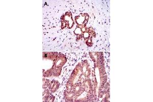 Immunohistochemical analysis of paraffin-embedded human prostate tissue (A) and colon cancer tissue (B) using OTX2 monoclonal antobody, clone 1H12C4B5  with DAB staining. (OTX2 anticorps)