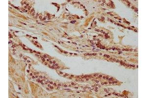 IHC image of ABIN7168592 diluted at 1:400 and staining in paraffin-embedded human prostate cancer performed on a Leica BondTM system. (SAGE1 anticorps  (AA 3-133))