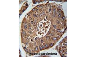 ACN9 Antibody (N-term) immunohistochemistry analysis in formalin fixed and paraffin embedded human hepatocarcinoma followed by peroxidase conjugation of the secondary antibody and DAB staining. (ACN9 anticorps  (N-Term))