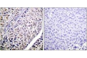 Immunohistochemistry analysis of paraffin-embedded human liver carcinoma tissue, using AurB (Ab-12) Antibody.