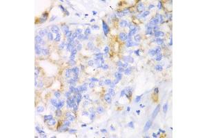 Immunohistochemistry of paraffin-embedded human liver cancer using CHIA antibody (ABIN5971776) at dilution of 1/100 (40x lens). (CHIA anticorps)