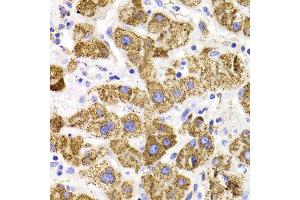 Immunohistochemistry of paraffin-embedded liver cancer using GATM antibody at dilution of 1:100 (x400 lens). (GATM anticorps)