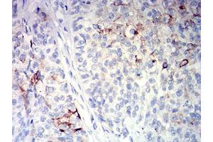 Immunohistochemical analysis of paraffin-embedded bladder cancer tissues using CD10 mouse mAb with DAB staining.