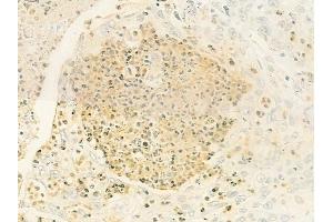 ABIN6264758 and ABIN6279799 at 1/100 staining human esophageal carcinoma by IHC-P. (RIOK1 anticorps  (C-Term))