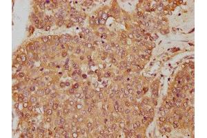 IHC image of ABIN7144729 diluted at 1:250 and staining in paraffin-embedded human liver cancer performed on a Leica BondTM system.