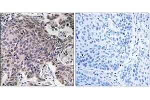Immunohistochemistry analysis of paraffin-embedded human lung carcinoma tissue, using MRPL54 Antibody. (MRPL54 anticorps  (AA 81-130))